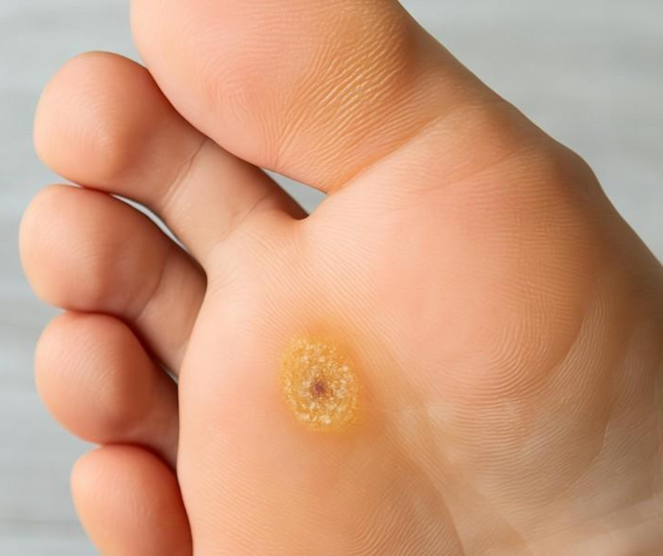 plantar wart