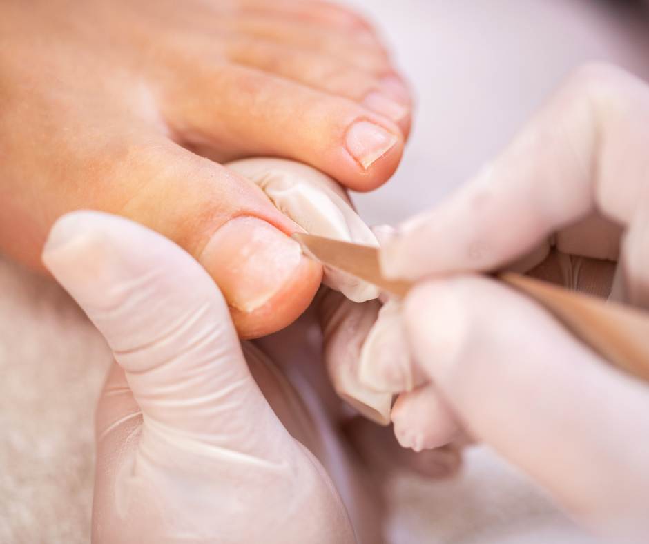 {posthttps://valleypodiatry.com/blog/how-to-stop-ingrown-toenail-pain/How to Stop Ingrown Toenail Pain_title}